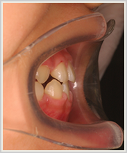 反対咬合-治療後-噛み合わせ側面