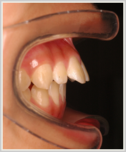 上顎前突-治療前-噛み合わせ側面