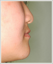 下顎前突-治療後-横顔
