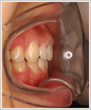 上下顎前突-治療後-噛み合わせ側面